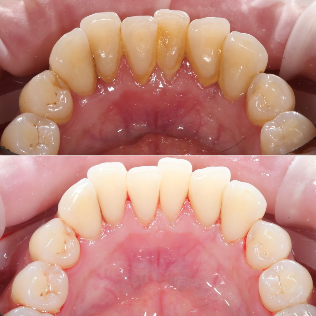 RAYON™ Supersonic Whitening Toothbrush