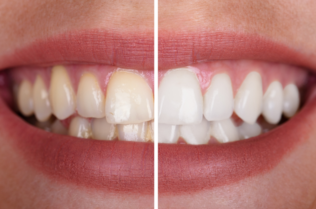 RAYON™ Supersonic Whitening Toothbrush